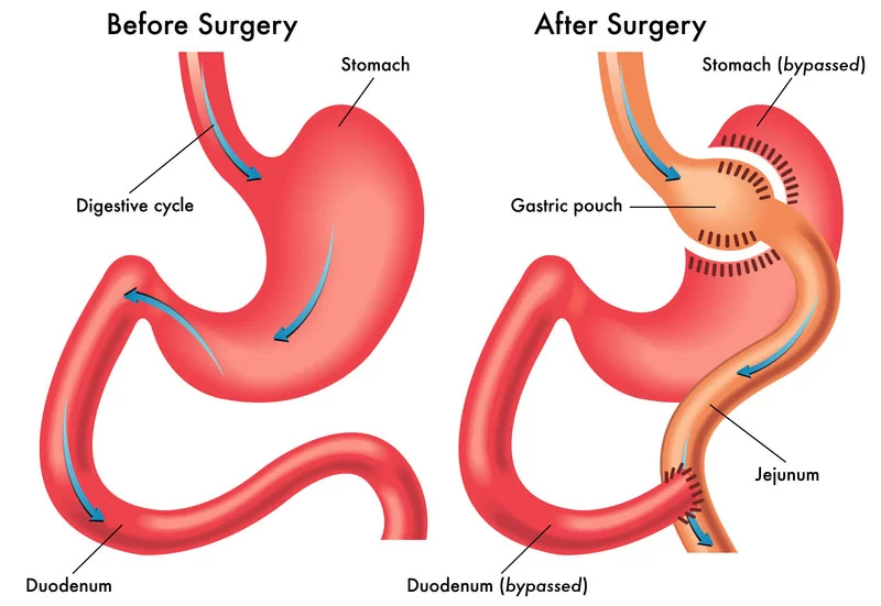 Gastric_Bypass_Illustration2.webp